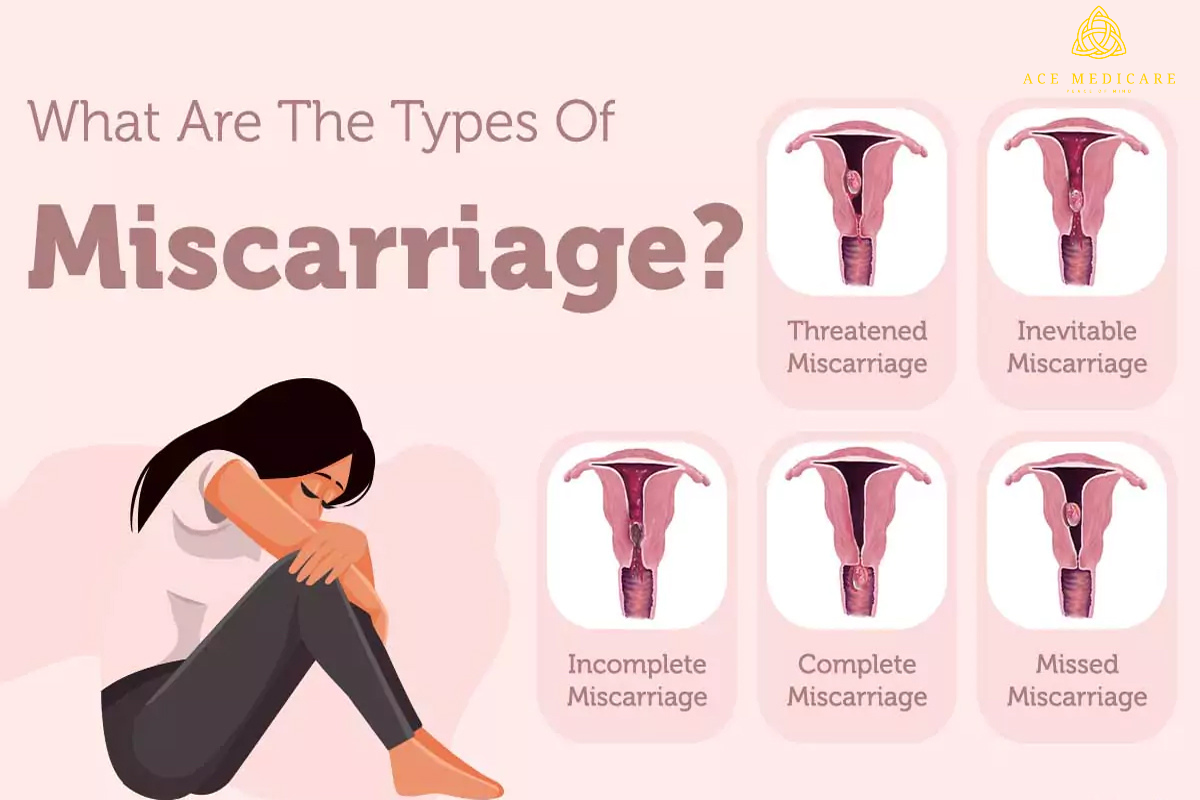 What exactly is a miscarriage?